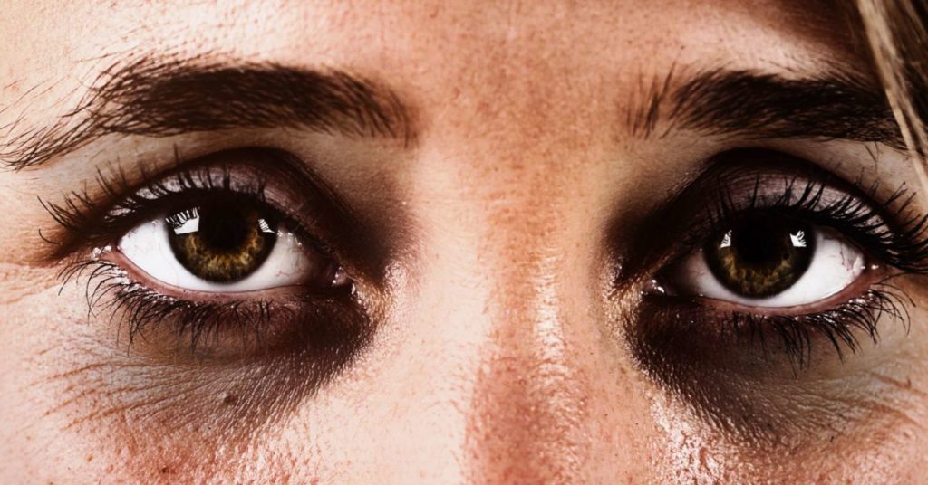 How are dark eye circles caused?