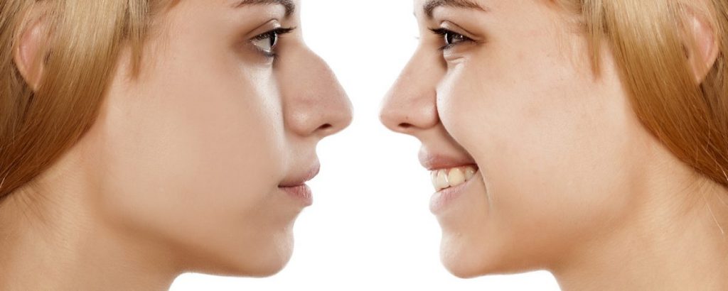 Rhinoplasty Surgery – Purpose and Proper procedures