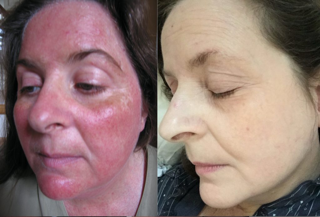 Consult The Certified Dermatologists Of Rosacea Treatment Singapore